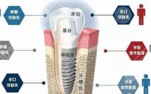 请问种植牙多少钱一颗医保能报销多少 种牙一般要多少钱一颗